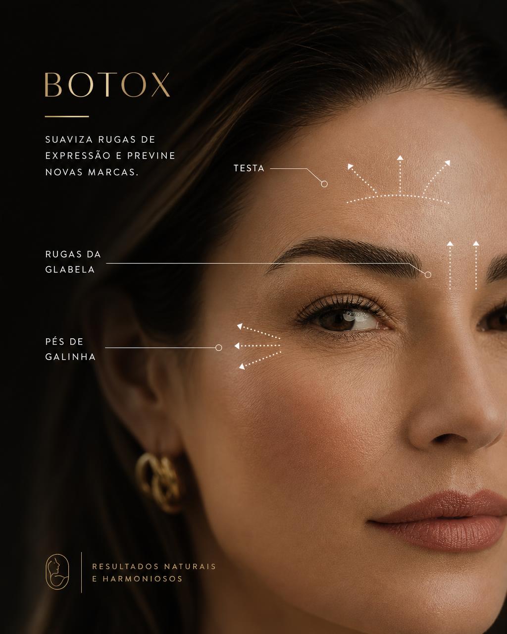Vídeo em breve: Botox